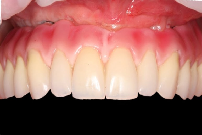 Dentida