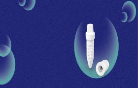 Bioimplantai - odontologijos klinika Kaunas